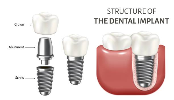A dental implant has been designed to artificially replace a natural tooth root and is inserted into the jawbone to support a restorative or replacement crown, bridge, or denture. They can be the best solution for people missing one or more teeth due to injury, periodontal disease, or other oral health problems. Benefits Success rates of treatment are over 95% They are durable and permanent Minimal maintenance is required other than good oral hygiene and professional dental checkups and cleanings Feel natural and comfortable and provide the best aesthetics Only tooth loss solution that prevents jawbone loss Teeth adjacent to the gap do not need to be modified Can be more cost-effective in the longer term, due to the long lifespan of the treatment Disadvantages  Treatment is more invasive – a surgical procedure is required to insert the implant The treatment takes longer and requires a greater number of dental visits compared to other options Most expensive tooth replacement solution When to Choose Dental Implants This is the best option if you are suitable for treatment and can afford dental implants. Treatment is a long-term solution for tooth loss and it provides the best aesthetic results.   Although treatment is more expensive, it can be more cost-effective in the longer term as implant restorations will not need to be replaced as often as a dental bridge. Additionally, an implant preserves the jawbone and the gum tissue, and there is no need for your dentist to grind down healthy teeth.