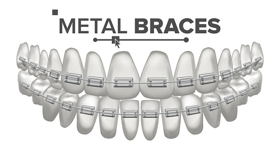 Download Metal Braces Vector Human Jaw Braces On Teeth Smile With ...