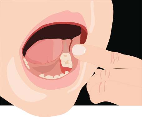 Missing Tooth (Vector)