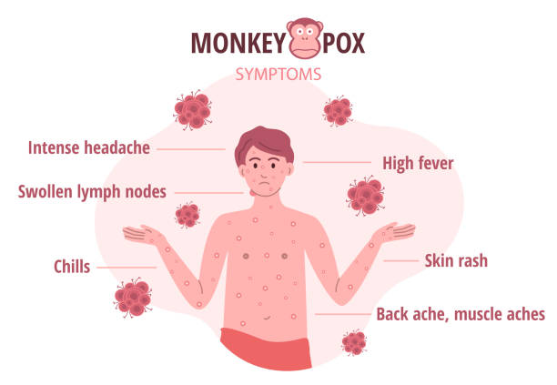 monkey pox outbreak. infographics of virus symptoms in humans. vector illustration for informing people about an infectious disease - 天花病毒 幅插畫檔、美工圖案、卡通及圖標