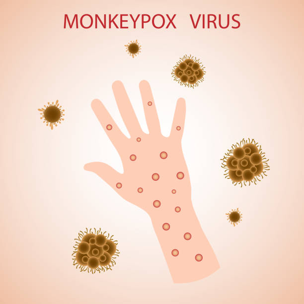 Monkey pox virus on the skin. The monkey pox virus is a viral disease that can affect humans and non-human primates. Monkey pox. Vector illustration Monkeypox virus on the skin on the arm.  The monkeypox virus is a viral disease that can affect humans and non-human primates. Monkey pox.  A banner to inform and warn about the spread of the disease, symptoms or precautions.Vector illustration monkey pox stock illustrations