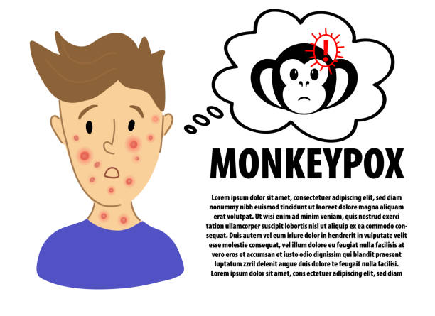 projekt banera infograficznego monkeypox. mężczyzna cierpiący na nowego wirusa monkeypox. znak ikony ostrzeżenia o wirusie ospie małpiej. płaski portret postaci z wysypką na twarzy - objawy ospy. - monkeypox stock illustrations