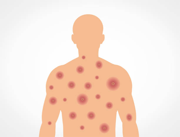 monkeypox virus and alert against disease spread, symptoms. monkey pox virus outbreak. - monkeypox 幅插畫檔、美工圖案、卡通及圖標