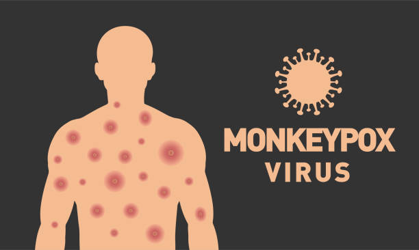 wirus ospy małpiej. projekt banera wirusa monkeypox. blizny na ciele. projektowanie wektorowe. - monkeypox stock illustrations