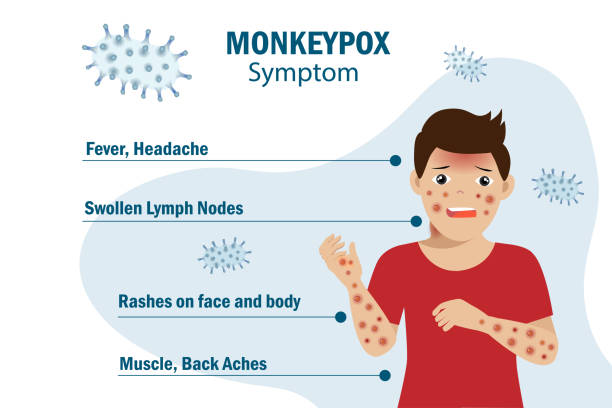 monkeypox virus symptom infographic on patient with fever, headache, swollen lymph node, rashes on face, body and back, muscle aches. for awareness in spreading of orthopoxvirus outbreak. - 猴痘 幅插畫檔、美工圖案、卡通及圖標