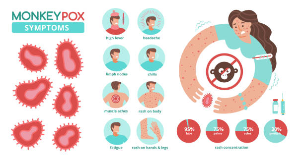 Monkeypox virus symptoms infographics. New orthopox virus outbreak worldwide spreading. Detailed info for people awareness in human diseases infection. Medical concept. Flat vector illustration. Monkeypox virus symptoms infographics. New orthopox virus outbreak worldwide spreading. Detailed info for people awareness in human diseases infection. Medical concept. Flat vector illustration monkeypox vaccine stock illustrations