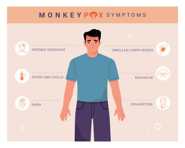 monkeypox virus symptoms. - 痘類病毒 幅插畫檔、美工圖案、卡通及圖標