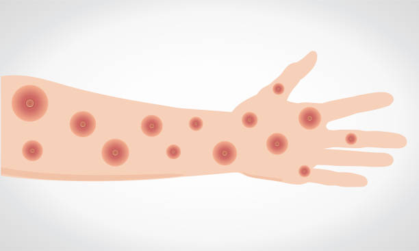 wirus ospy małpiej. rany na dłoni i ramieniu. vectorial - monkeypox stock illustrations