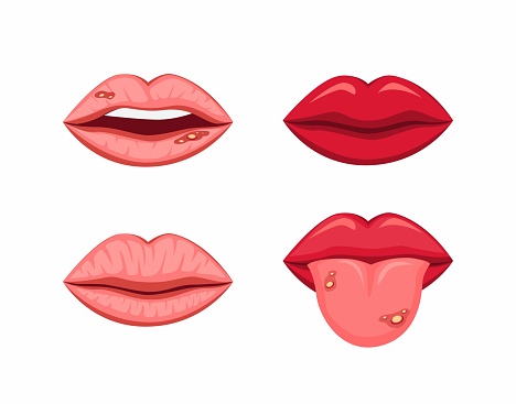 Mouth lips with tongue healthy and disease ulcer stomatitis symbol dental clinic health concept in cartoon illustration vector