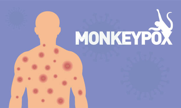stockillustraties, clipart, cartoons en iconen met multi-country monkeypox outbreak in non-endemic countries. body wound, measles, chicken pox. - monkeypox