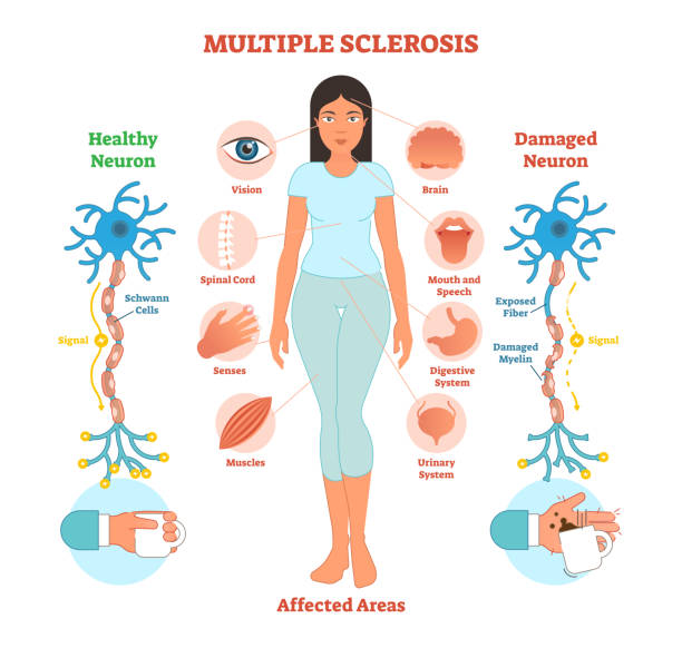 Multiple sclerosis anatomical vector illustration diagram, medical scheme. Multiple sclerosis anatomical vector illustration diagram, medical scheme with affected area icons and damaged neuron bio anatomy. multiple sclerosis stock illustrations