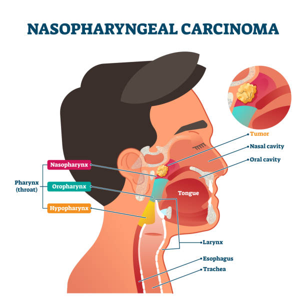 Nasopharyngeal carcinoma tumor, vector illustration Nasopharyngeal carcinoma tumor, vector illustration labeled diagram. Medical nose, mouth and throat cross section scheme with problem area. Health care educational information. Nasal and oral cavity neck stock illustrations