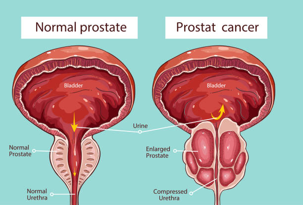 pastile pentru prostata fizioterapie pentru tratamentul prostatitei