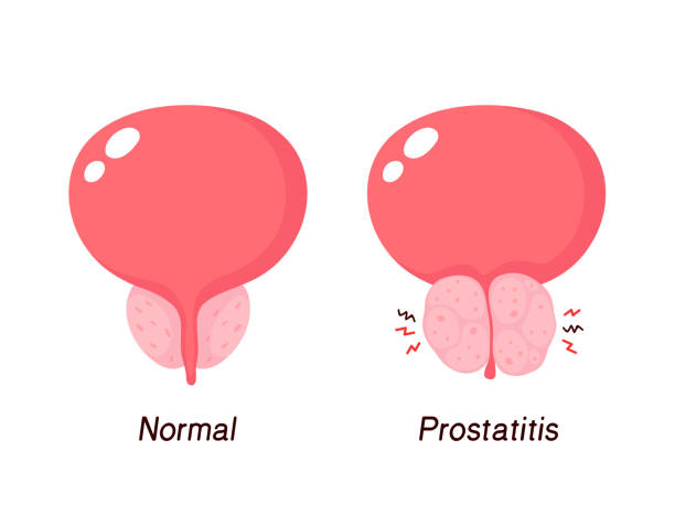 prostatitis hogyan kell ülni
