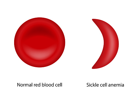Normal Red Blood Cell And Sickle Cell Anemia Stock ...