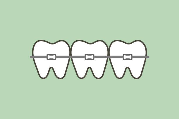 矯正歯または歯のかっこ - 矯正歯科医点のイラスト素材／クリップアート素材／マンガ素材／アイコン素材