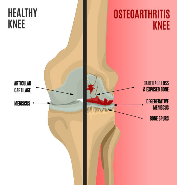 Osteoarthritis Knee Poster Osteoarthritis of the knee. Editable vector illustration in detailed realistic style isolated on a light background. Medical, healthcare and physiology concept. Side by side scientific infographic. osteoarthritis stock illustrations