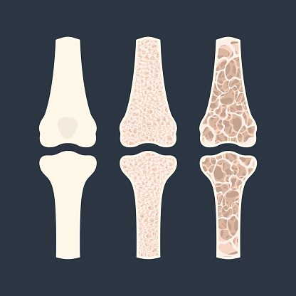 Osteoporosis disease stages. Bone density loss infographic banner. Normal bone versus osteoporotic bone. Skeletal system disease. Health care and medical concept. Vector illustration.