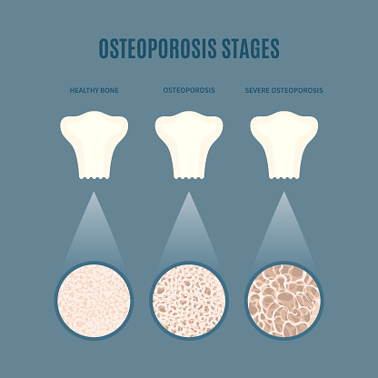 Osteoporosis stages infographic set of bone mass loss process. Different density femur cavity tissue close-up. Skeletal system disease. Senior osteopathy medical concept for diagnostics centers.