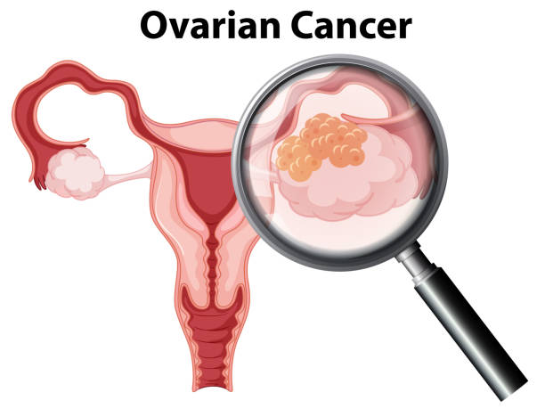 Ovarian Cancer on White Background vector art illustration