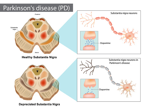 Parkinson's disease (PD). Normal and Depreciated Substantia Nigra