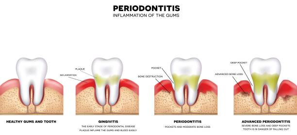 Gum Disease