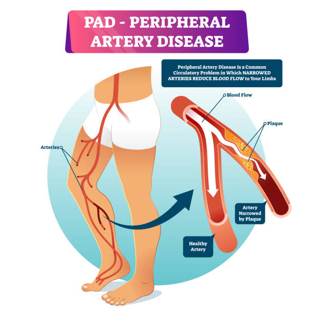 Peripheral artery disease PAD vector illustration. Labeled medical scheme. Peripheral artery disease PAD vector illustration. Labeled medical structure scheme with healthy or narrowed plaque in vessels comparison. Anatomical damaged peripheral organ and blocked blood example illness stock illustrations