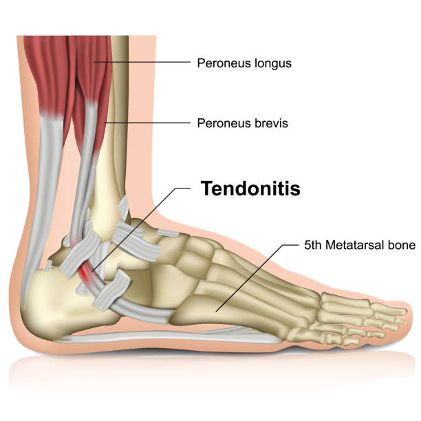 peroneal tendonitis ,ankle joint 3d medical vector illustration peroneal tendonitis ,ankle joint 3d medical vector illustration eps 10 foot anatomy stock illustrations