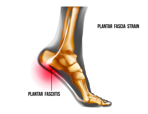 Plantar fasciitis inflammation and ruptures strain. Foot pain, realistic anatomy illustration Plantar fasciitis inflammation and ruptures strain. Bones ot Foot pain realistic illustration. Medial view. Anatomy of joints, human leg black and yellow transparente skeleton. For medical orthopedic advertising. Vector illustration stock vector. plantar fasciitis stock illustrations