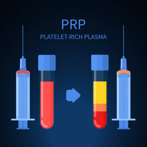 platelet rich plasma treatment procedure infographic poster - knee injection stock illustrations