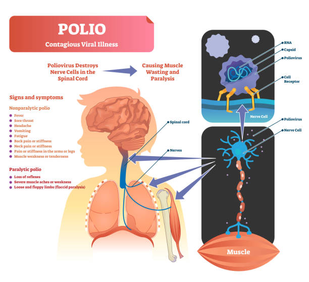 Polio vector illustration. Labeled medical virus infection symptoms scheme. Polio vector illustration. Labeled medical virus infection symptoms explanation scheme. Closeup process how inhaled disease affects muscles. Health danger diagnosis that causes paralysis and pathology polio stock illustrations