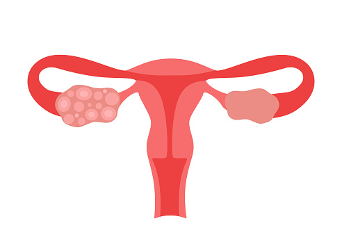 Polycystic ovary syndrome PCOS of woman. Female reproductive system disease. Abnormal uterus internal organ. Vector illustration