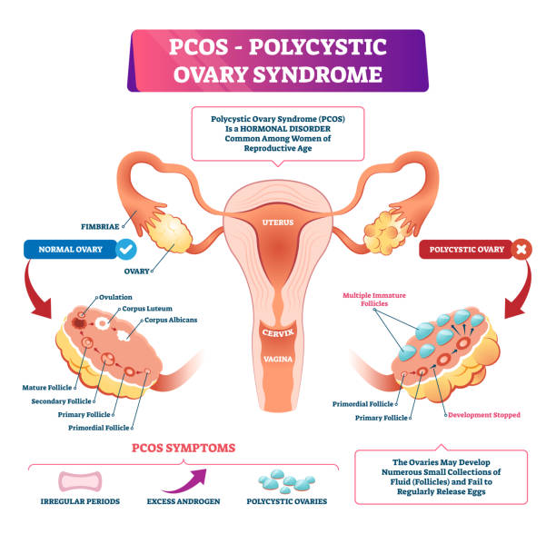 Polycystic ovary syndrome vector illustration. Labeled reproductive disease Polycystic ovary syndrome or PCOS vector illustration. Labeled internal reproductive disease comparison scheme with healthy and sick female organs. Set of anatomical symptoms due to elevated androgens labeling illustrations stock illustrations