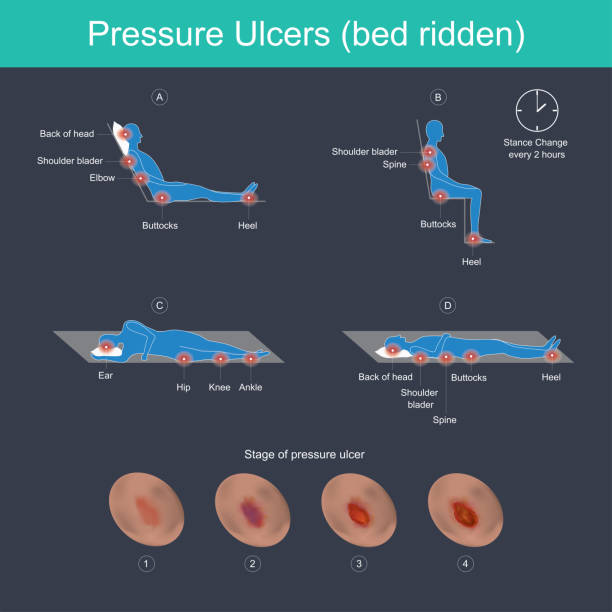Pressure Ulcers (bed ridden). Pressure ulcers are injuries to the skin, primarily caused by prolonged pressure on the skin. They can happen to anyone, but usually affect people confined to bed or who sit in a chair or wheelchair for long periods of time. pressure ulcer stock illustrations