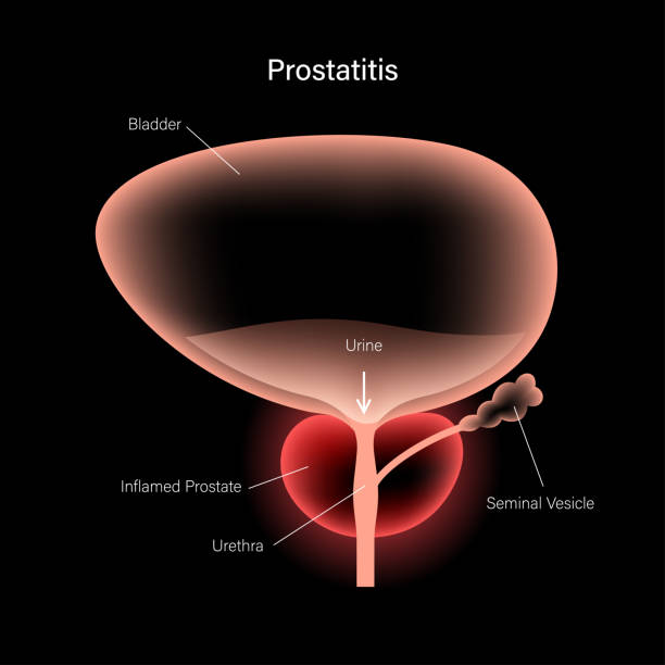 Prostatitis élet