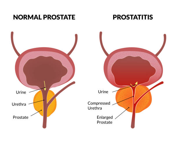 inflamatia prostata urine retention causes