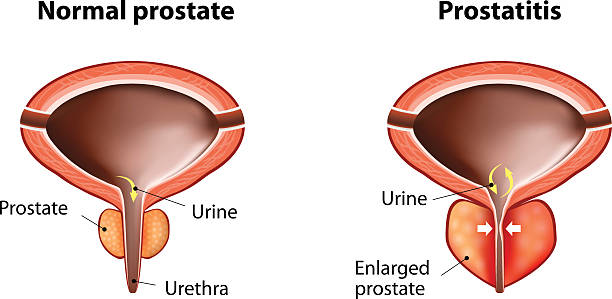 Prostatitis a hátsó miatt)