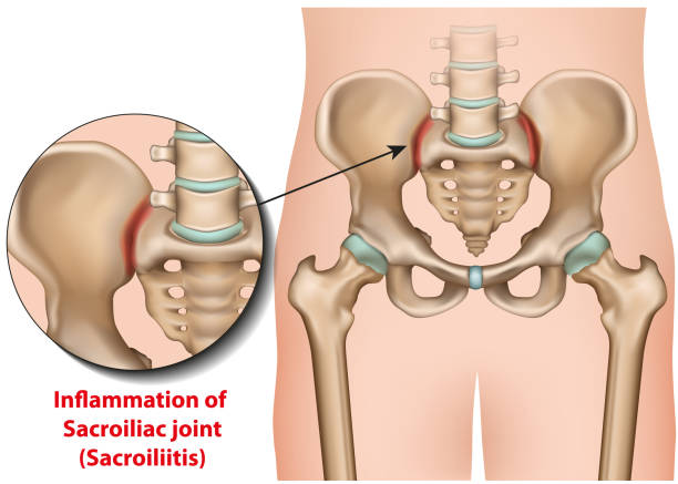 Sacroiliac joint inflammation 3d medical vector illustration sacroiliitis Sacroiliac joint inflammation 3d medical vector illustration sacroiliitis eps 10 joint body part stock illustrations