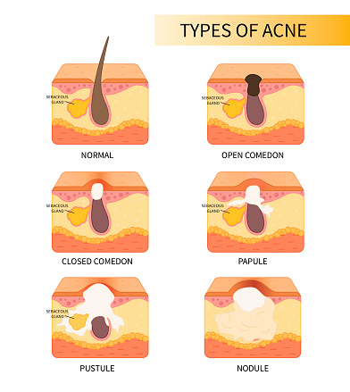 Scheme Of Different Types Of Acne Stock Illustration - Download Image ...