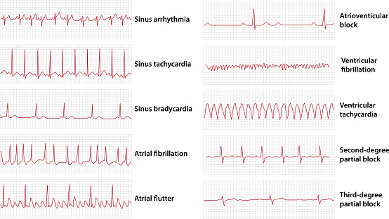 Scheme set of common electrocardiogram (ECG) abnormalities