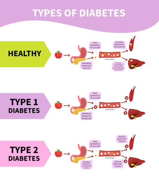 Scheme types of diabetes. Medical scheme types of diabetes. hyperglycemia stock illustrations