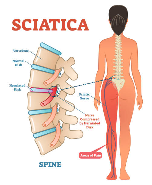 Sciatica medical health care vector illustration diagram scheme with lower spine and sciatic nerve pain in leg. Sciatica medical health care vector illustration scheme with lower spine and sciatic nerve pain in leg. Backbone diagram with vertebrae, disks and nerves. Full woman patient body from back. spine body part stock illustrations