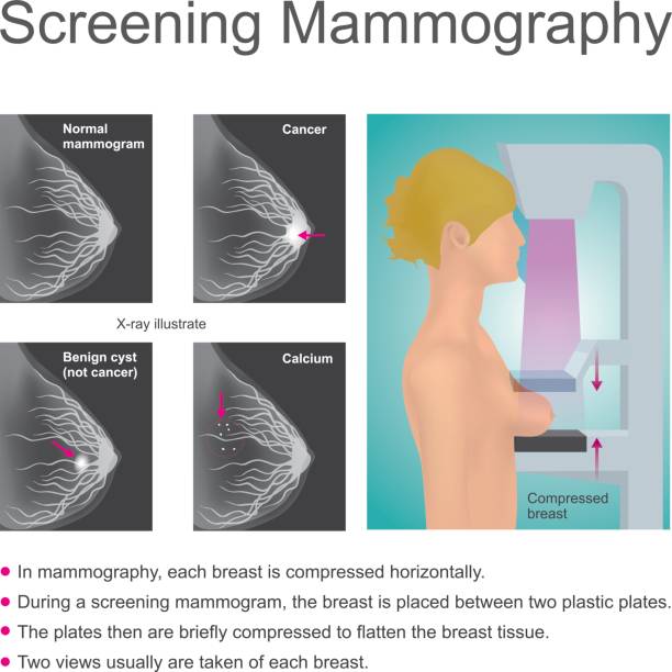 Screening mammography Mammography is the process of using low energy X-rays to examine the woman breast for diagnosis and screening. The goal of mammography is the early detection of breast cancer. Illustration chart vector. x ray plates stock illustrations