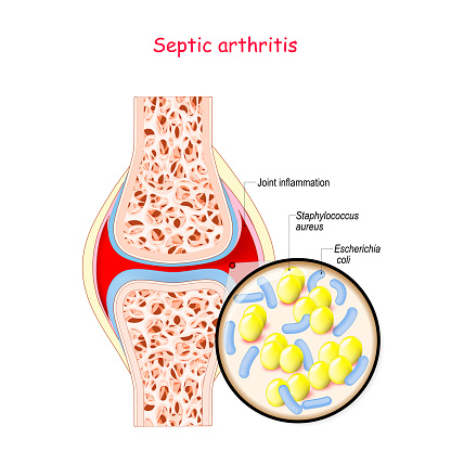 Arthritis adalah septic Radang Sendi,