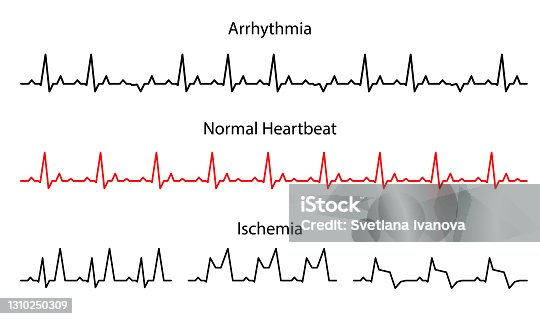 istock Set Lines heartbeat normal, arrhythmia and ischemia. 1310250309