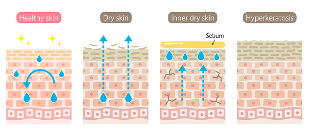 set of skin type. Dry, inner dry, oily, healthy, and hyperkeratosis skin cell layer. Healthy and Beauty skin care concept