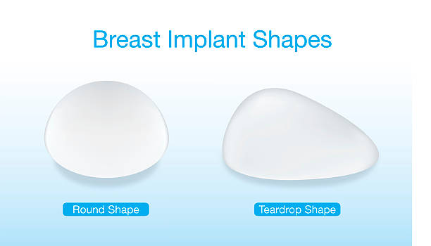 Shapes of breast implant Difference of breast implant round and teardrop shapes. This illustration about cosmetic surgery. silicone stock illustrations