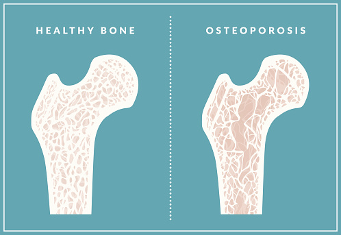 Simple illustration comparing healthy bone and osteoporosis