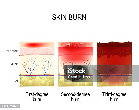 istock skin burn. Three degrees of burns. 884179078