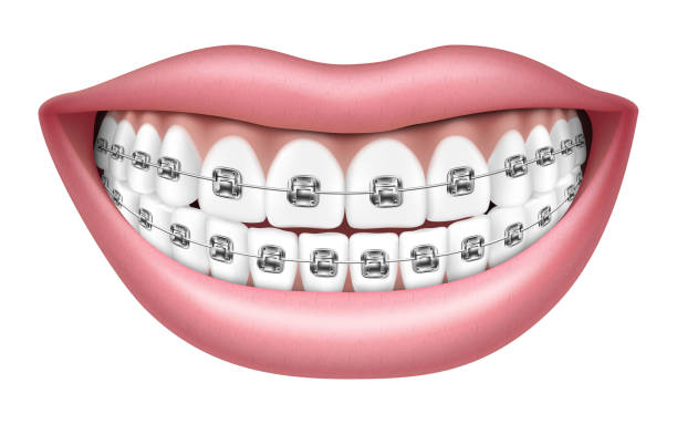 白い歯と中かっこで微笑みます。写実的な 3d ベクターイラストレーション、 白い背景に分離、 - 矯正歯科医点のイラスト素材／クリップアート素材／マンガ素材／アイコン素材